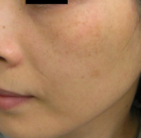 肝斑 セラクリニック