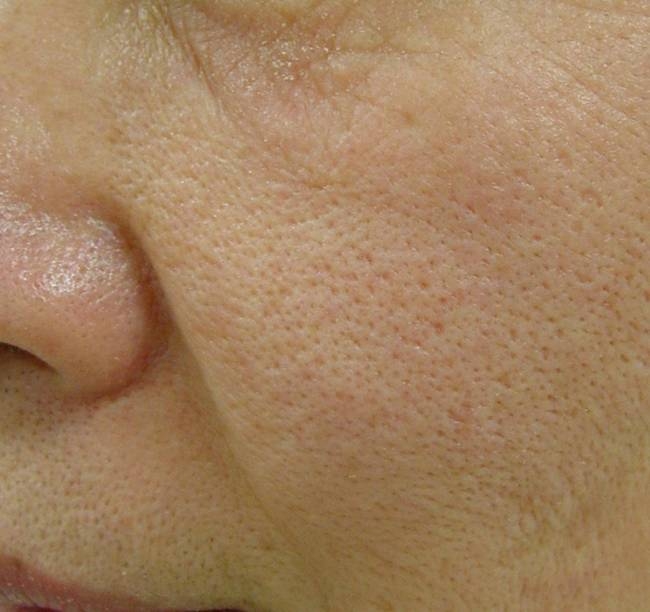 毛穴 セラクリニック