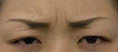 治療別項目　ボトックス　眉間治療前.jpg