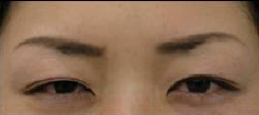 治療別項目　ボトックス　眉間ボトックス治療後.jpg