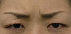 治療別項目　ボトックス　眉間治療前.jpg