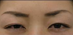 治療別項目　ボトックス　眉間ボトックス治療後.jpg
