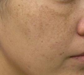 melasma before.jpg