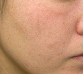 melasma after.jpg