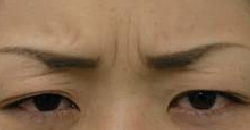 治療別項目 ボトックス 眉間治療前.jpg