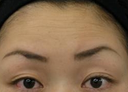 治療別項目 ボトックス 前額部治療前.jpg