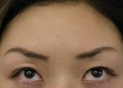 治療別項目 ボトックス 前額部ボトックス治療後.jpg